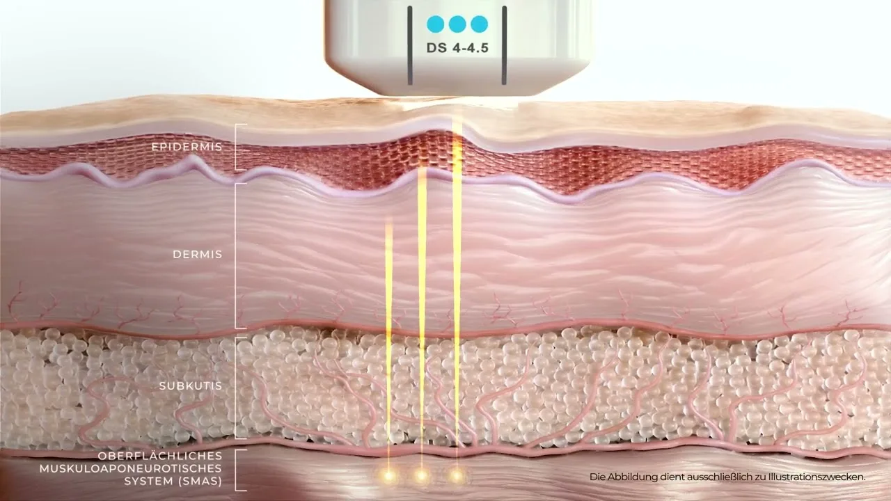 Standbild aus dem Film: der Applikator gibt Energie durch Epidermis und Dermis bis in das SMAS ab